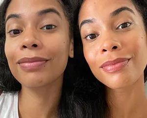 Foundations For Acne Prone Skin Featuring L'Oréal Infallible On Person Before and After Application